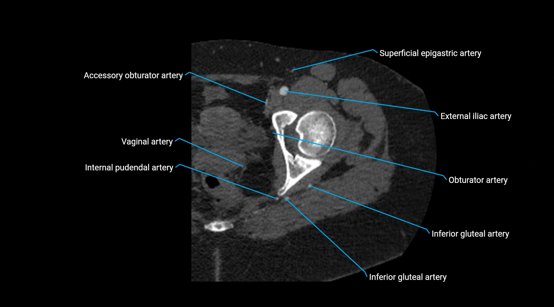 CTA lower limb cross sectional anatomy labelled image _54.webp